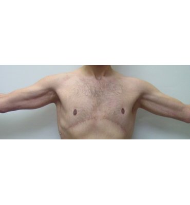 mastectomy and brachioplasty